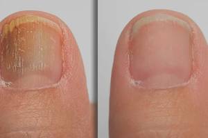 L’astuce simple contre les infections des ongles